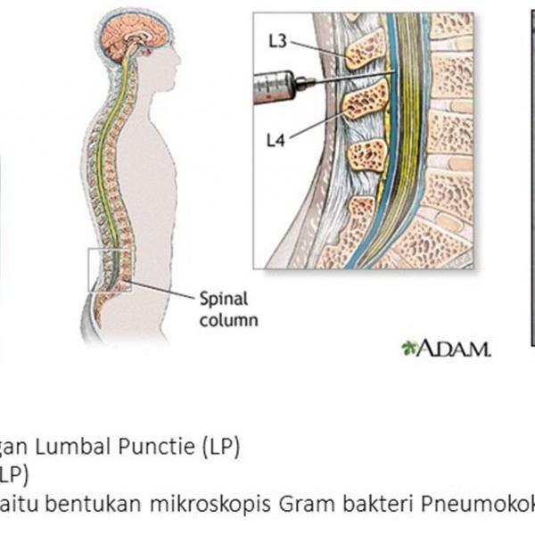 MENINGITIS BAKTERI