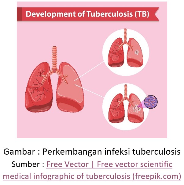 Deteksi Infeksi Laten Tuberkulosis (ILTB)