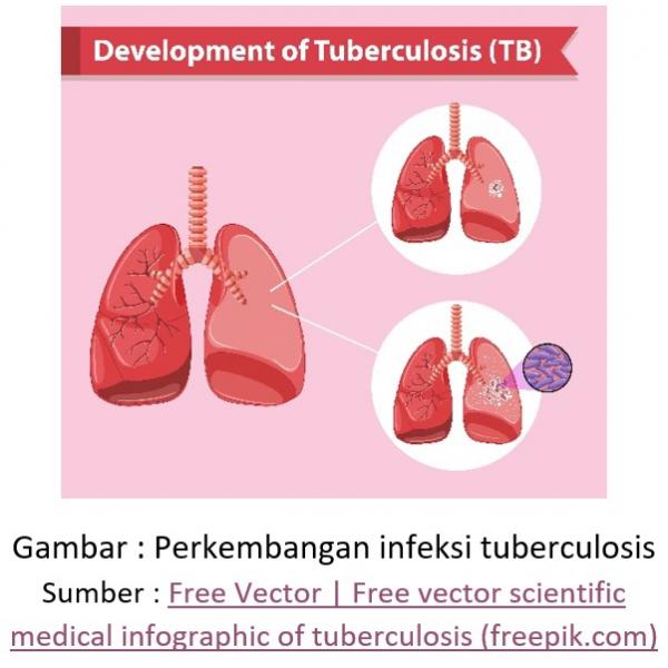 Deteksi Infeksi Laten Tuberkulosis (ILTB)