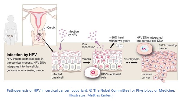Kanker serviks dikarenakan virus HPV