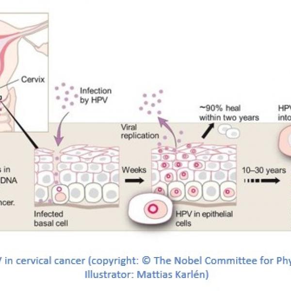 Kanker serviks dikarenakan virus HPV