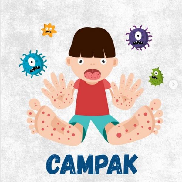 Campak pada Dewasa: Bukan Sekadar Penyakit Anak